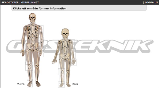 Interaktiv steg-för-steg anvisning om hur man gipsar olika frakturer