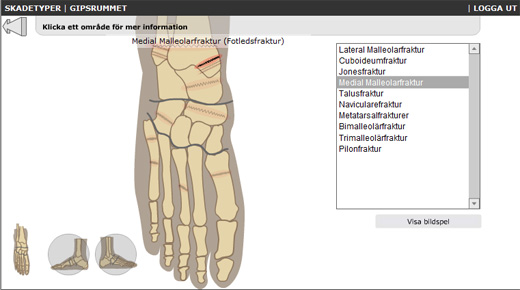 Interaktiv steg-för-steg anvisning om hur man gipsar olika frakturer