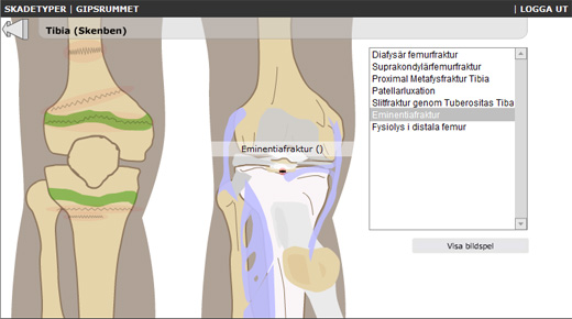 Interaktiv steg-för-steg anvisning om hur man gipsar olika frakturer